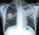 Tbc röntgen