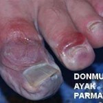 donma_ayak_parmaklari donma_ayak_parmaklari