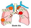 lung ca