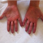 raynaud raynaud